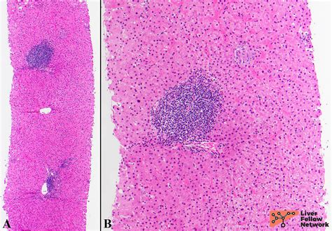 The Liver Biopsy Importance And Interpretation Aasld