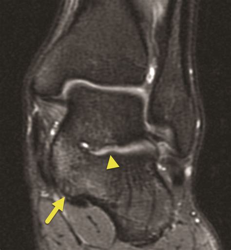 Talocalcaneal Coalition Applied Radiology