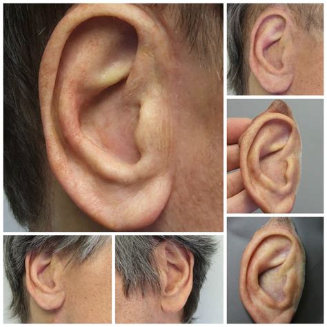 Auricular Photo Gallery Medical Art Prosthetics