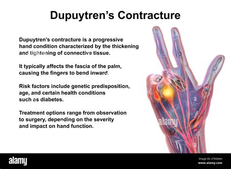 A 3d Medical Illustration Displaying A Patients Hand With Dupuytrens