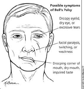 Facial Palsy Causes Symptoms Diagnosis Treatment Public Health Notes