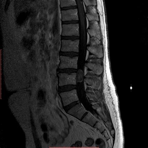 Spinal Schwannoma Image Radiopaedia Org