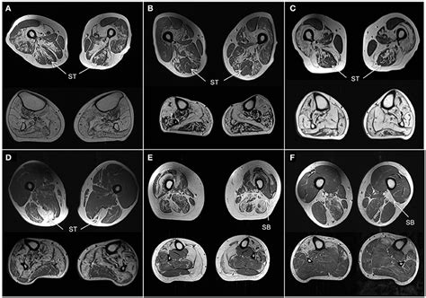 Frontiers The Diagnostic Value Of Mri Pattern Recognition In Distal