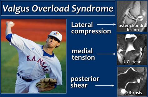 Valgus Extension Overload Symptoms Causes Treatment By Elbow Braces