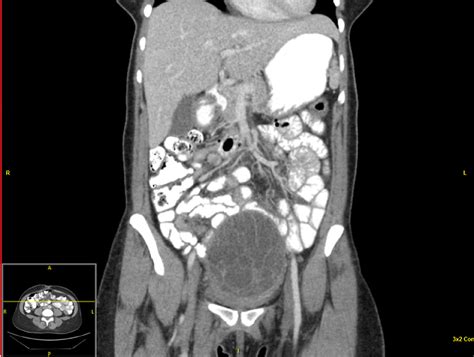 Persistent Ovarian Remnant Leading To Borderline Mucinous Tumor