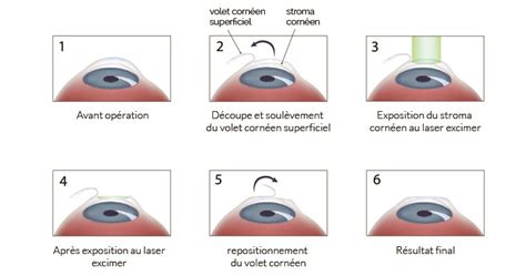 Lasik Tunisie Prix Op Ration Des Yeux Au Laser Pas Cher