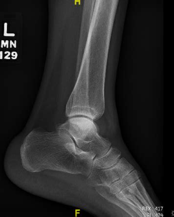 Ankle Arthrocentesis in the Emergency Department — BROWN EMERGENCY ...