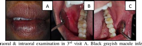 Figure 4 From Management Of Ulcerative Oral Lichen Planus Predisposed By Psychological Stress