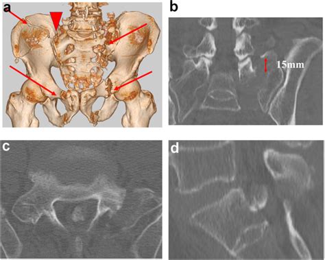 Preoperative Computed Tomography Scan A Arrows Indicate Fracture Download Scientific Diagram