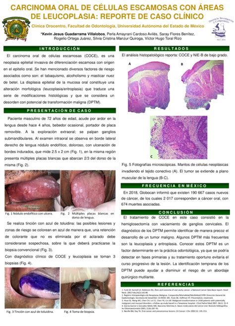 Pdf Carcinoma Oral De CÉlulas Escamosas Con Áreas De Leucoplasia Reporte De Caso ClÍnico