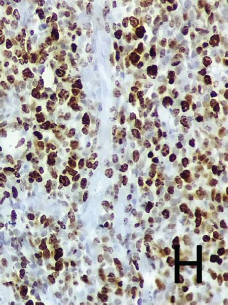 Histopathological Features In A The Histologic Section From The