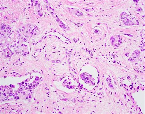 Inflammatory Breast Cancer Histology