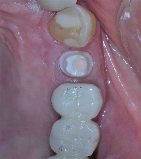 Cement Choices For Implant Crowns Lee Ann Brady Dmd