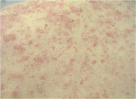 Drug Induced Lupus Erythematosus