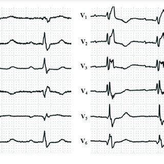 Twelve Lead Electrocardiogram During Sinus Rhythm Showing Complete