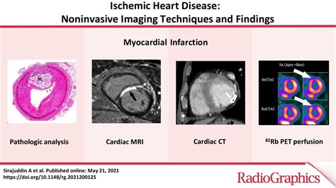 Ischemic Heart Disease Noninvasive Imaging Techniques And Findings