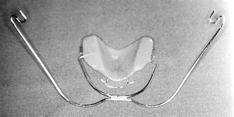 Design And Fabrication Of A Modified Protraction Headgear For Class Iii Long Face Patients