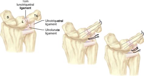 Peripheral Tears Of The Tfcc Arthroscopic Diagnosis And Management