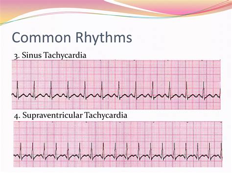 12 Lead Ekg Interpretation Ppt