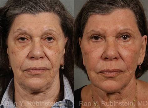 Fraxel Laser Before And After Wrinkles - change comin