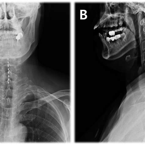 Anteroposterior View A And Lateral View B Plain X Rays Taken After Download Scientific