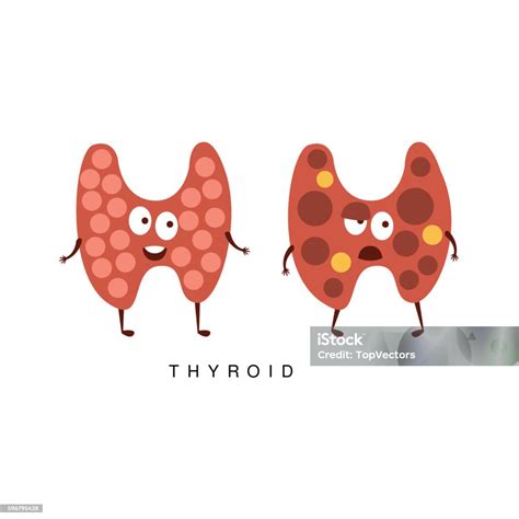 Ilustrasi Infografis Tiroid Sehat Vs Tidak Sehat Ilustrasi Stok Unduh