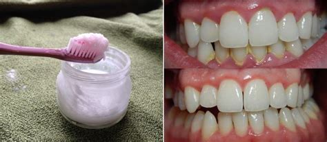 how to get rid of plaque from teeth