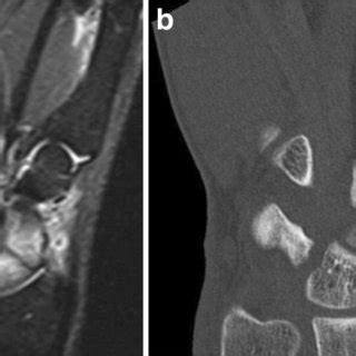 a MRI of the left wrist a few hours after a fall demonstrating a... | Download Scientific Diagram