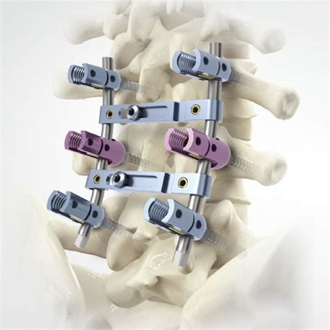 Sistema de Fijación Vertebral CROWNVAL