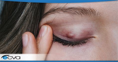 What Is A Stye Eye Care And Vision Associates