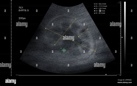 Sonogram Of Human Kidney Illustration Ultrasound Diagnostic Stock