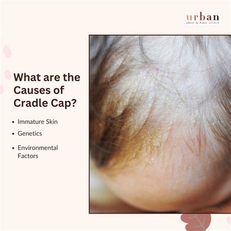 cradle cap types  symptoms treatment urban skin  hair clinic