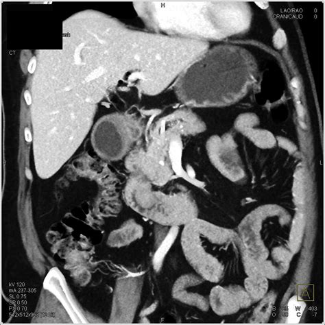 Ampullary Carcinoma Obstructs Common Bile Duct Cbd And Invades