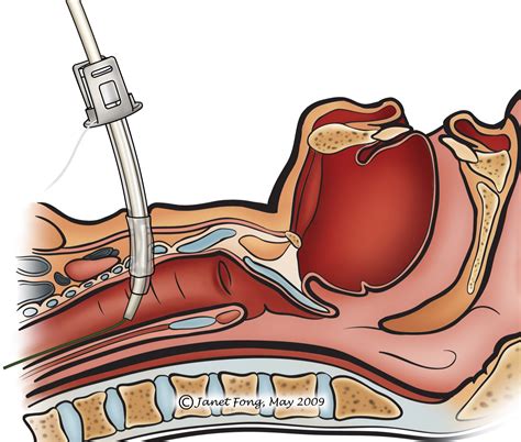 Percutaneous Dilational Tracheostomy Procedure Instructions 52 Off