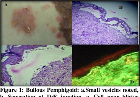 Figure 1 From Histmorphological Profile And Direct Immunofloresence In Subepidermal Bullous