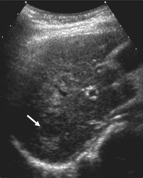 Liver Cancer Ultrasound