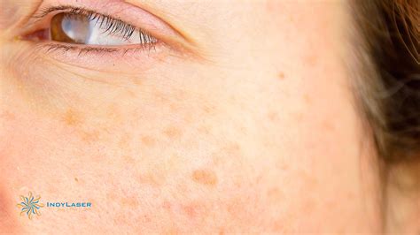 How To Get Rid Of Sun Spots On Your Skin Heidi Salon