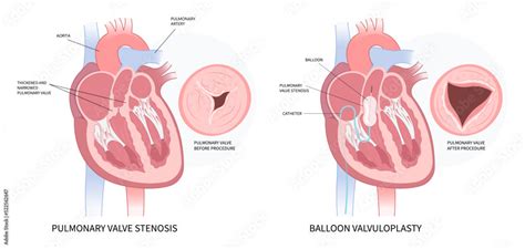 left atrial atresia and heart rhythm syndrome cardiac murmur disease ...