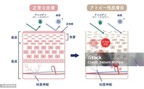 Cross Section Of Normal Skin And Atopic Dermatitis Stock Illustration