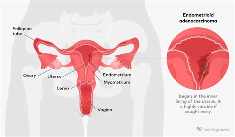 Endometrioid Adenocarcinoma Symptoms Stages Causes