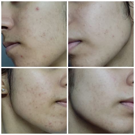 Review Minimalist Alpha Arbutin Serum Used For Months R