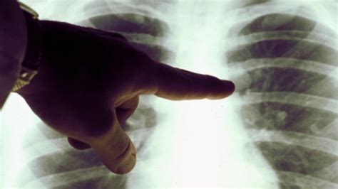 New Pill Shows Promise In Treating Lung Cancer Patients