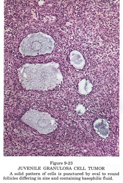 Pathology Outlines Granulosa Cell Tumor Juvenile