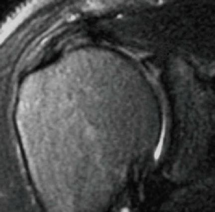 Magnetic resonance image of a Type 2 SLAP tear with concomitant partial... | Download Scientific ...