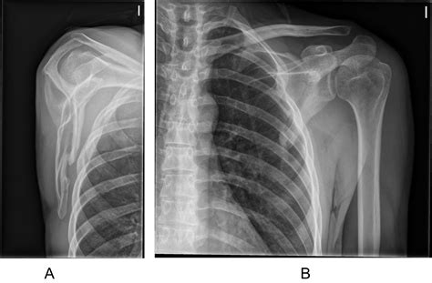 Right Scapula Fracture