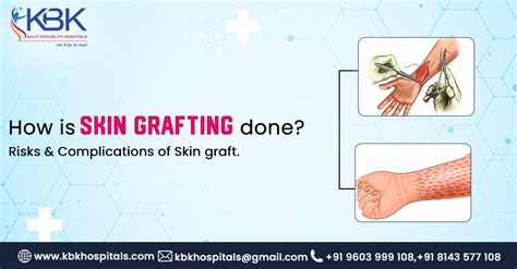 How is Skin grafting is done? it's risks & complications of skin graft.