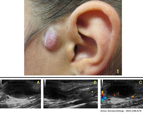 Preauricular Pits Overview And More
