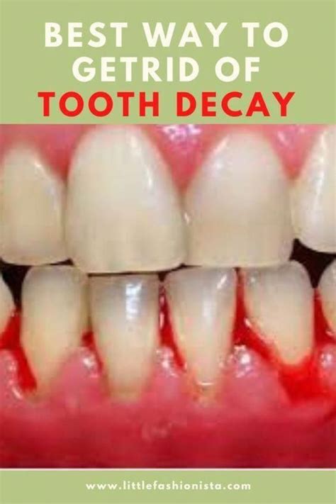 Get Rid Of Cavities And Tooth Decay Artofit