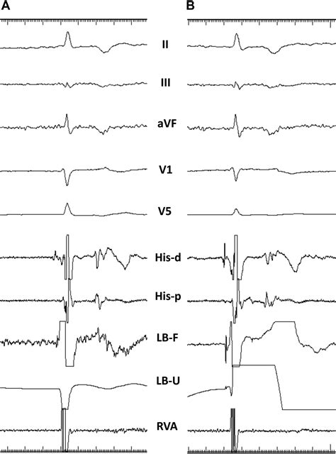 My Preferred Approach To Left Bundle Branch Pacing Lumenless Leads