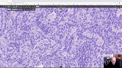 Adenosquamous Carcinoma Phillip H McKee Antonina Kalmykova CSD Health